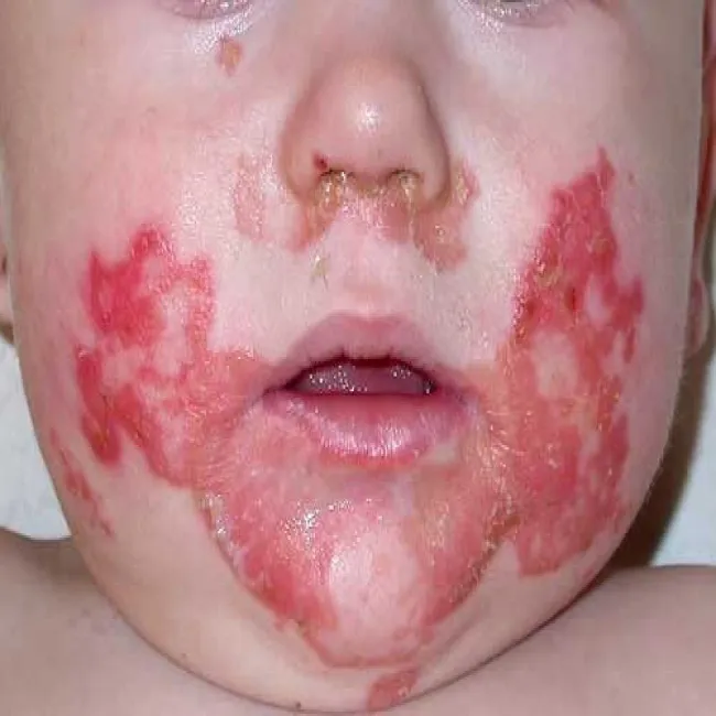 Niedobór cynku u dzieci zespół Danbolta-Clossa