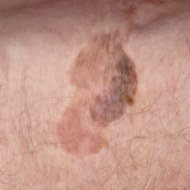 Nieinwazyjny rak skóry choroba Bowena