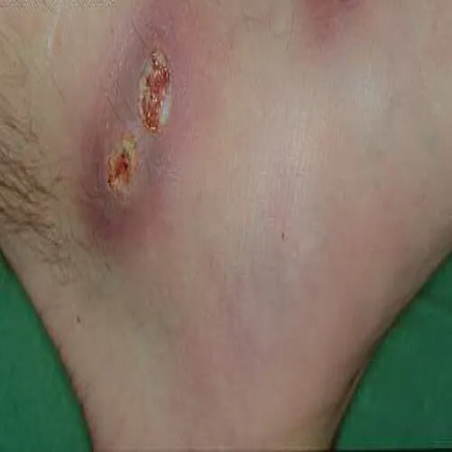 Niesztowica paciorkowiec ropotwórczy  