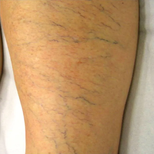 Niewydolność żylna zdjęcia