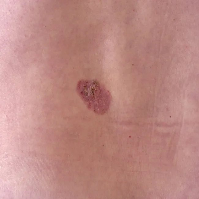 Nowotwór skóry BBC