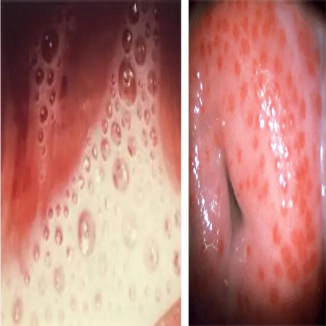 Obfite upławy choroba rzęsistkowica