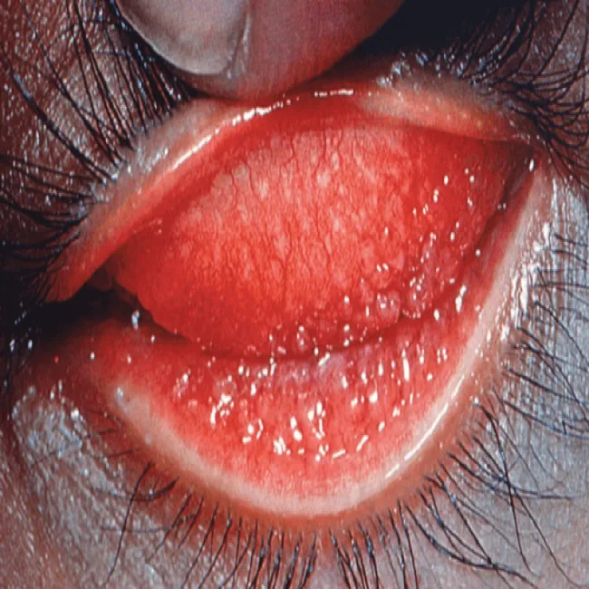 Objawy choroby oczu w chorobie wenerycznej chlamydiozie