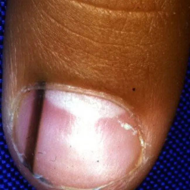 Objawy czerniaka paznokcia