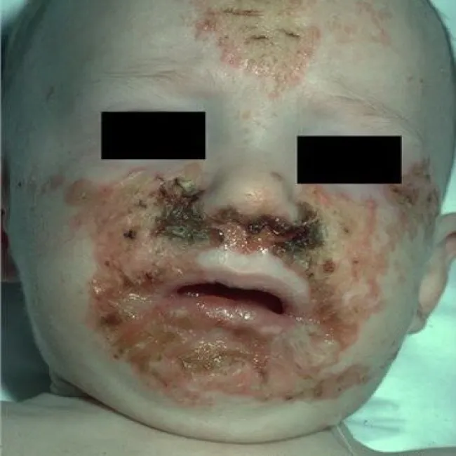 Objawy niedoboru cynku u dzieci zespół Danbolta-Clossa