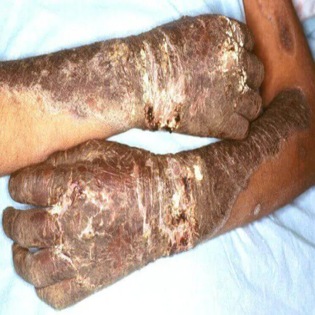 Objawy rumień lombardzki 