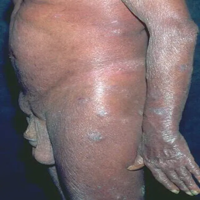 Objawy zespół Sezary’ego 