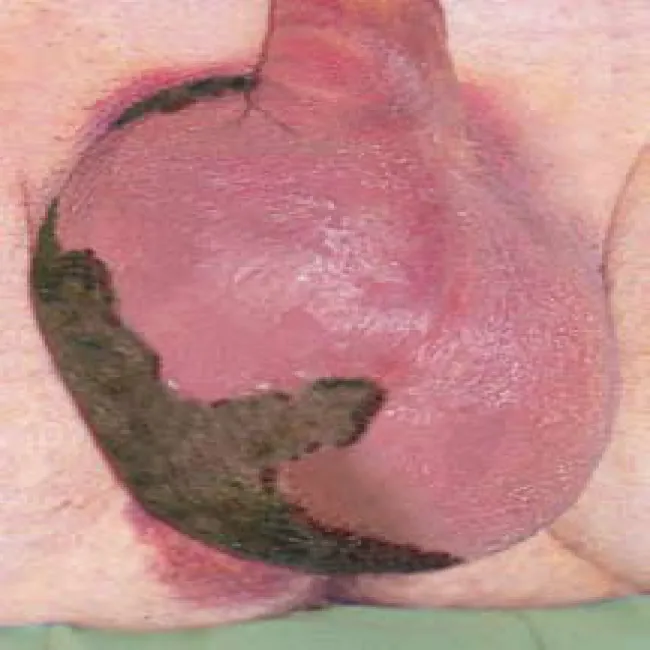 Obrzęk moszny choroba zgorzel Fourniera 