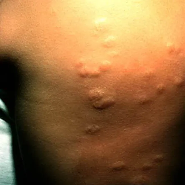 Obrzęk pokrzywkowy na skórze - choroba anetoderma