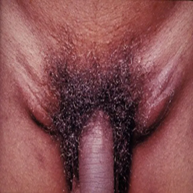 Obrzęk węzłów chłonnych pachwinowych ziarnica weneryczna pachwin