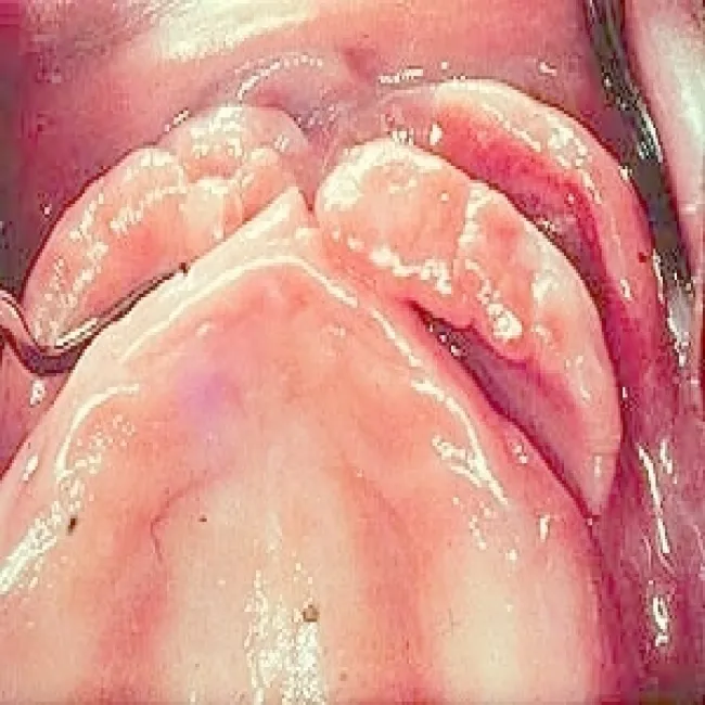 Obwodowy ziarniniak olbrzymiokomórkowy 