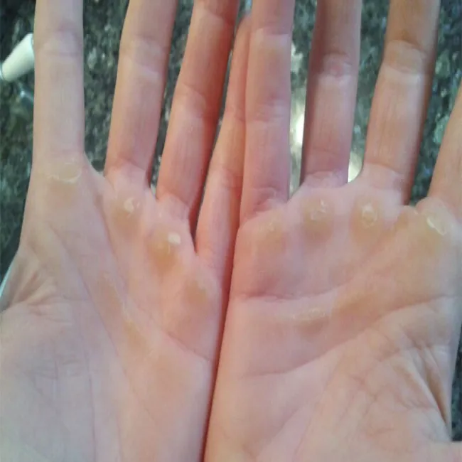 Odciski na dłoniach