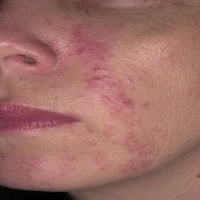 Okołoustne zapalenie skóry