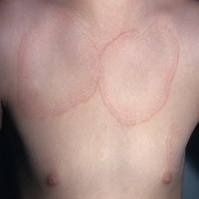 Okrągłe plamy na skórze ziarniniak obrączkowaty 