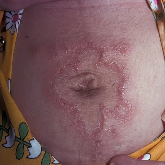 Opryszczka ciążowa