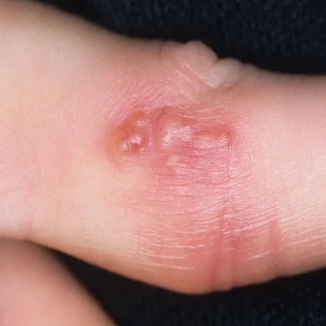 Opryszczka na palcu