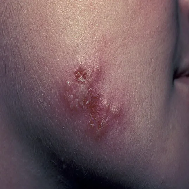 Opryszczka u dziecka