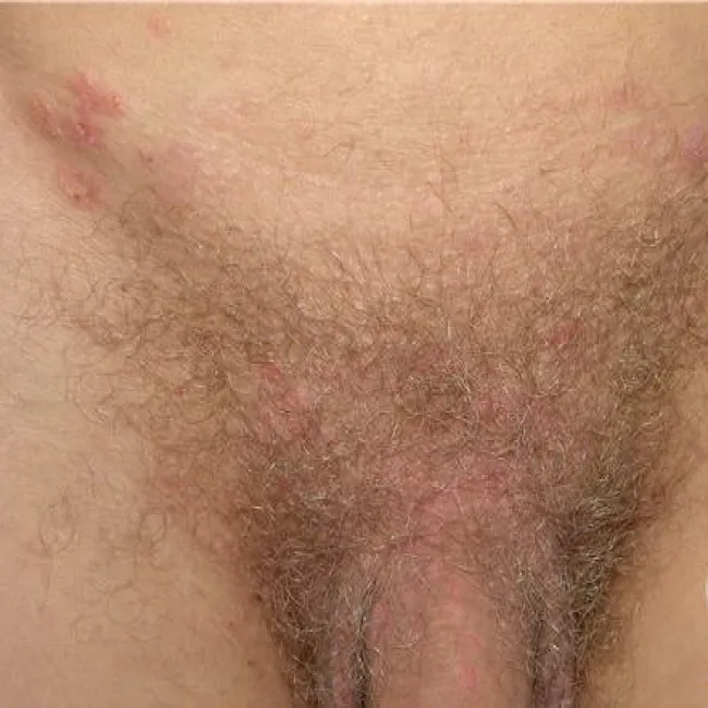 Opryszczkowate zapalenie skóry miejsc intymnych