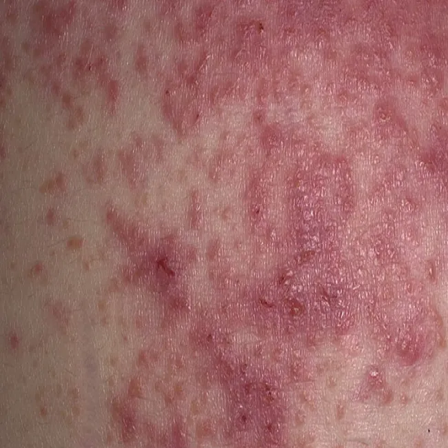 Opryszczkowate zapalenie skóry zdjęcie
