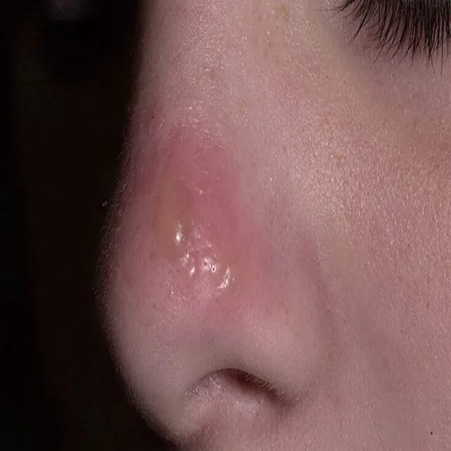 Opryszka zwykła na nosie
