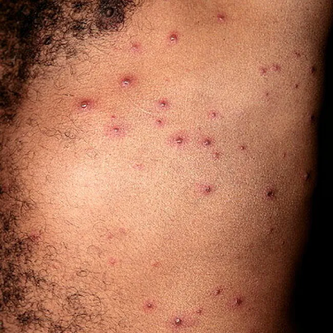 Ospa wietrzna u dorosłego mężczyzny