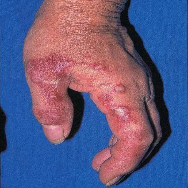 Ostra gorączkowa dermatoza neutrofilowa 