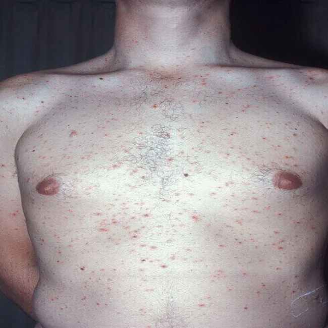 Ostra postać przyłuszczycy