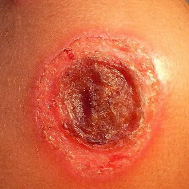 Owrzodzenie z uniesionym brzegiem niesztowica