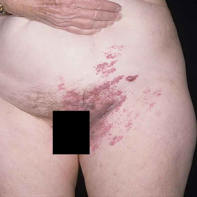 Półpasiec u kobiety okolice intymne