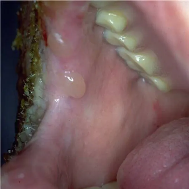 Pęcherz w jamie ustnej