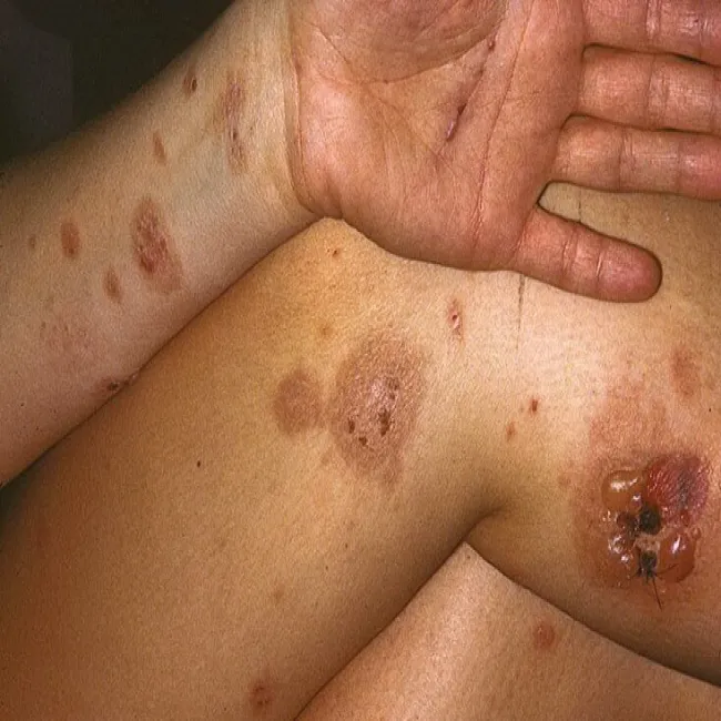 Pęcherz z płynem rumień wokół