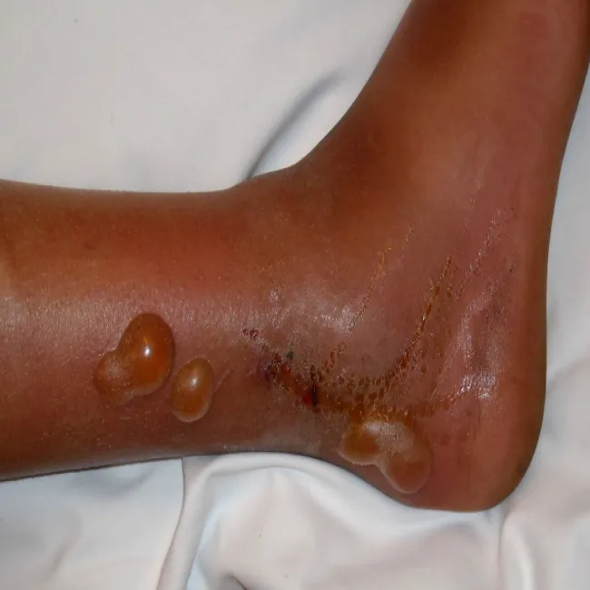 Pęcherze na skórze liszajec