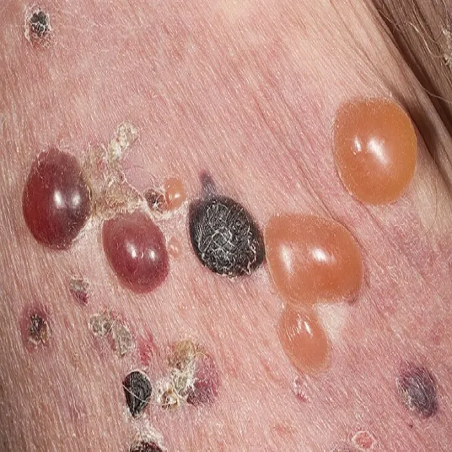 Pęcherze na skórze zdjęcia