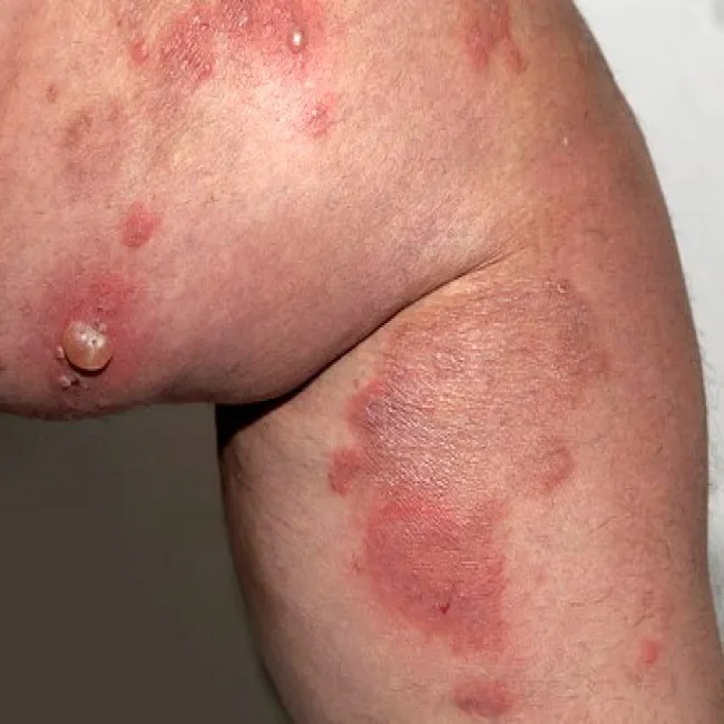 Pęcherze skórne opryszczkowate zapalenie skóry