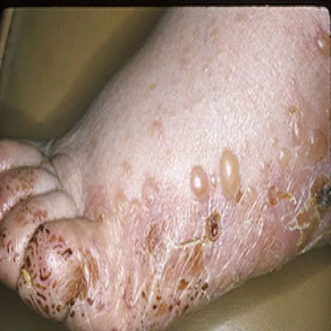 Pęcherze wypełnione płynem na stopach