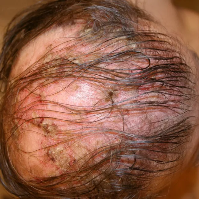 Pęcherzyca pospolita na głowie