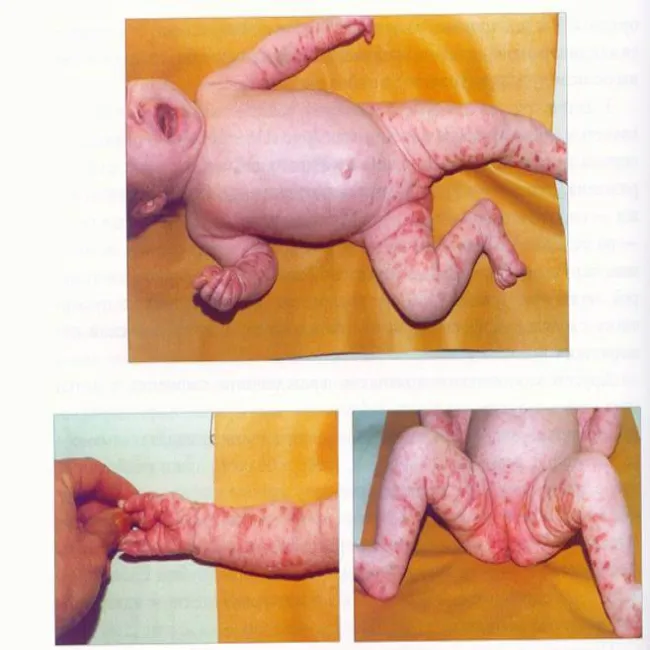 Pęcherzyca syfilityczna