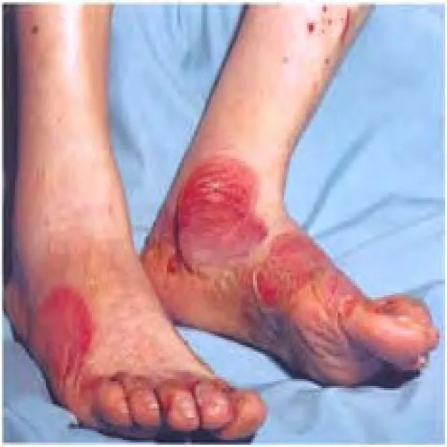 Pęcherzyca zwykła na stopach