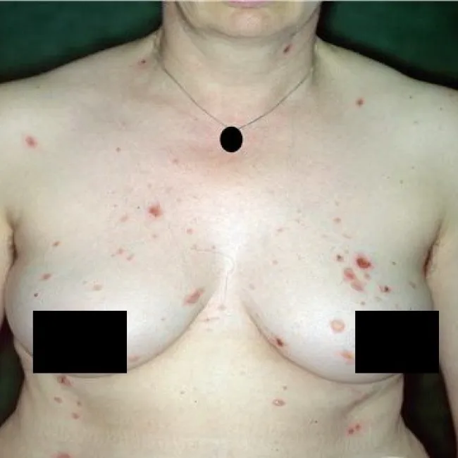 Pęcherzyca zwykła u kobiet