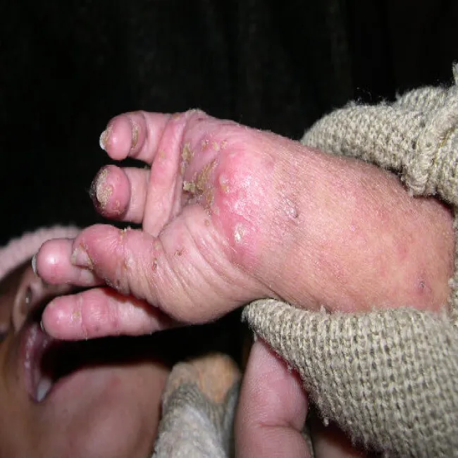 Pęcherzyki na dłoniach rękach u dziecka świerzb