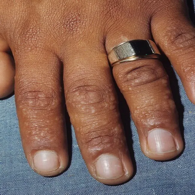 Pęcherzyki na dłoniach wyprysk potnicowy