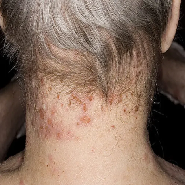 Pęcherzyki z płynem surowiczym na szyi