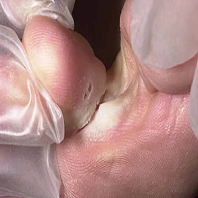 Pękająca skóra między palcami u nóg stopa atlety