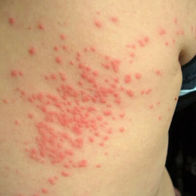 Płonica u dziecka na skórze