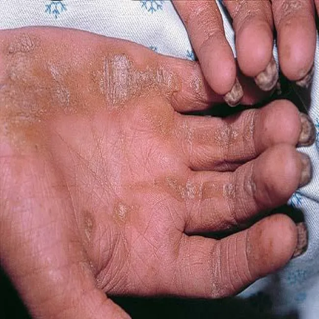 Pachyonychia wrodzona