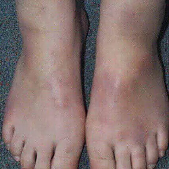 Panniculitis jak wygląda zdjęcie