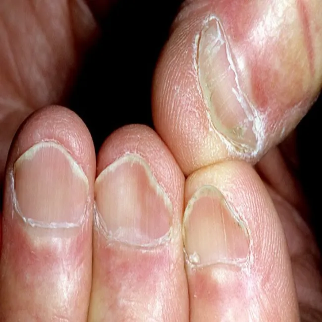 Paznokcie łyżeczkowate zdjęcie