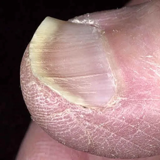 Paznokcie wklęsłe zdjęcie