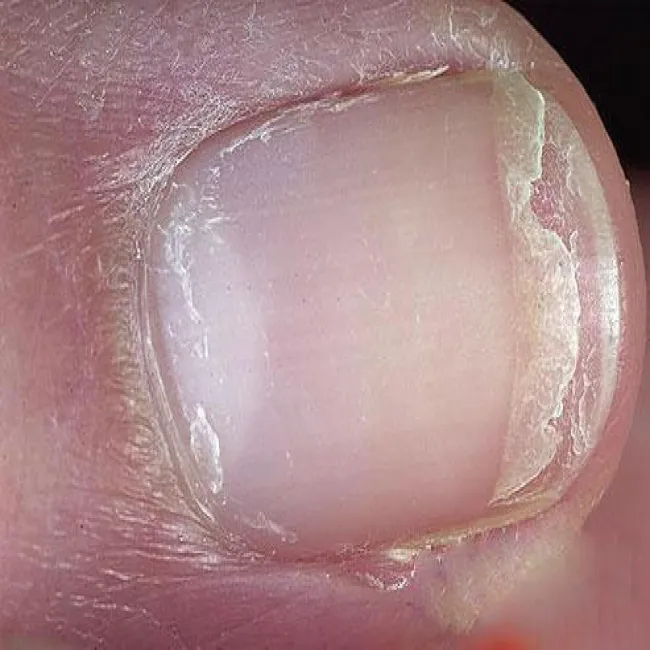 Paznokieć łuszczyca