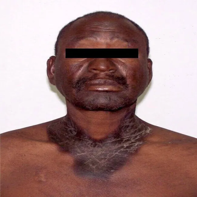 Pelagra choroba zdjęcie